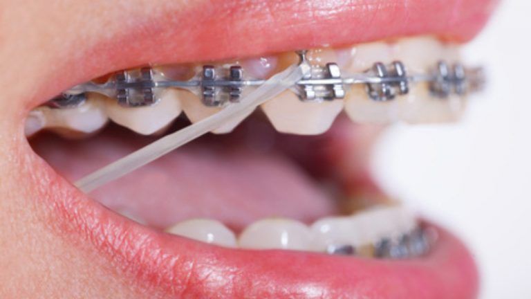 ¿Para qué sirven las gomas de los brackets?