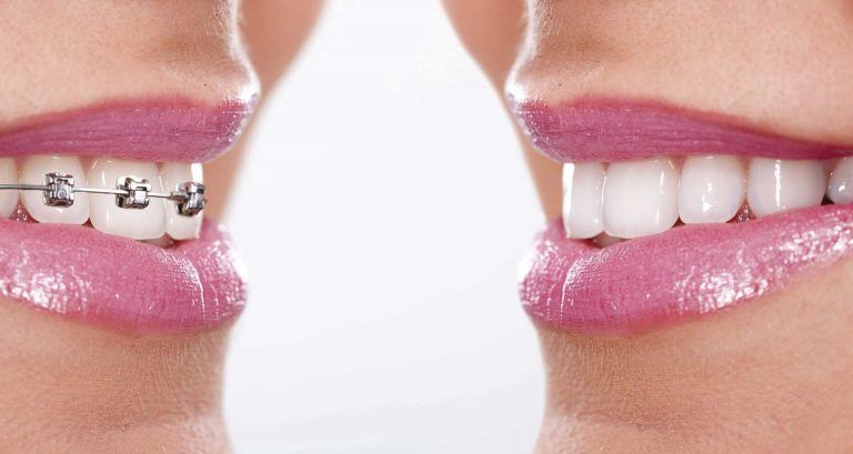 ¿Qué es mejor usar brackets o Invisalign?